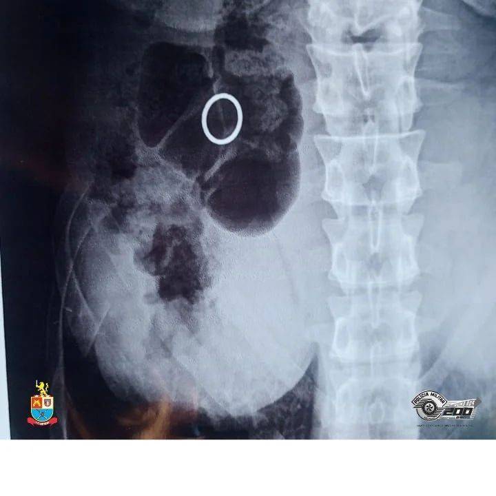 Homem é Preso por Suspeita de Furtar e Engolir Anel de R$ 7 Mil em Mogi das Cruzes